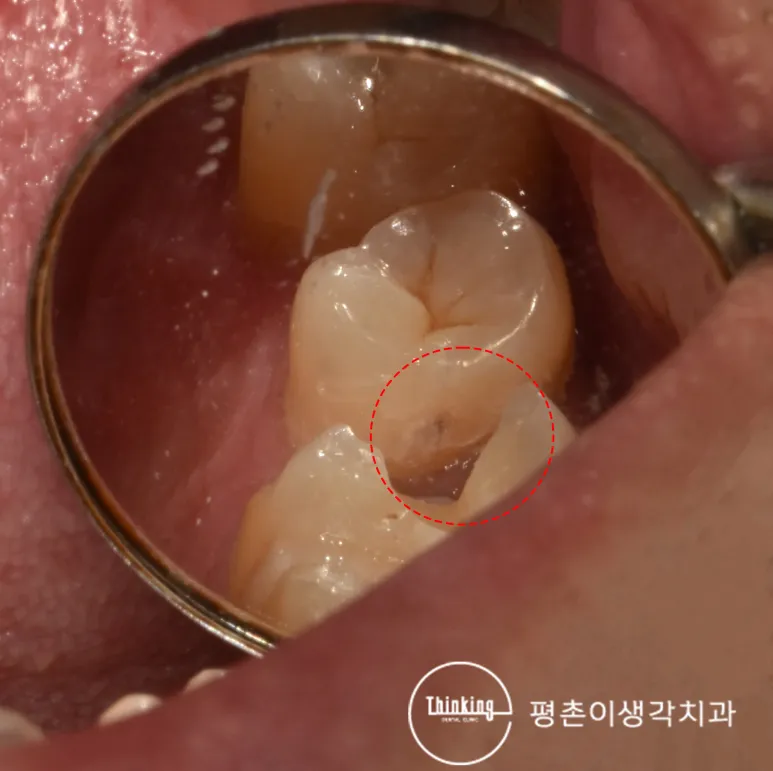 구강거울에 비친 어금니 인접면의 어두운 우식 부위를 붉은 점선으로 표시한 사진