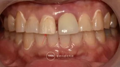라미네이트 떨어짐으로 앞니 수복물이 탈락한 치료 전 정면 구내 사진