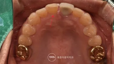 라미네이트 떨어짐 후 위쪽에서 바라본 앞니 삭제면과 인접 치아 상태