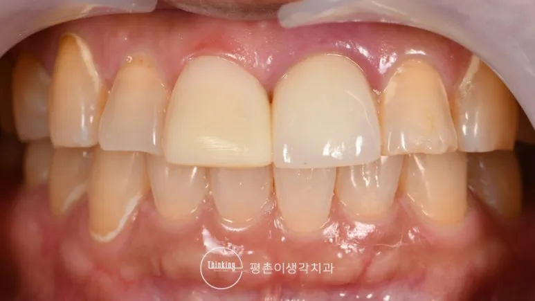 새로운 라미네이트 제작을 위해 앞니 상태를 정리하고 인상채득을 준비한 모습