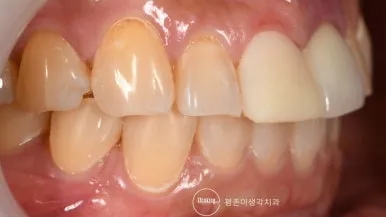 라미네이트 떨어짐 후 앞니에 장착한 임시 레진 라미네이트를 측면에서 본 모습