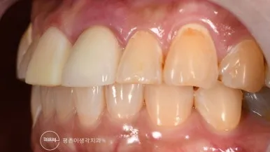 임시 레진 라미네이트를 장착한 반대쪽 측면과 잇몸선 상태
