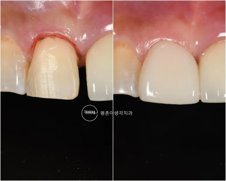 라미네이트 떨어짐 치료 전과 최종 보철물 장착 후를 비교한 앞니 근접 사진