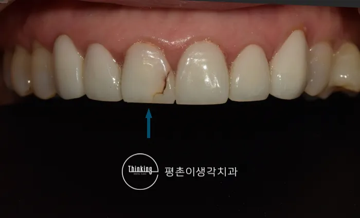 앞니 라미네이트가 파절된 부위를 화살표로 표시한 구내 사진