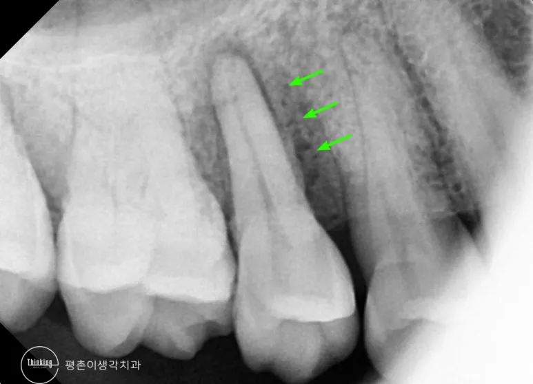 어금니 뿌리 옆 잇몸뼈가 녹아내린 부위를 초록 화살표로 표시한 치근단 방사선 사진