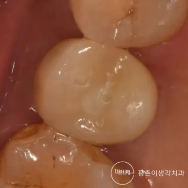 지르코니아 크라운을 장착한 어금니 교합면 구강 사진