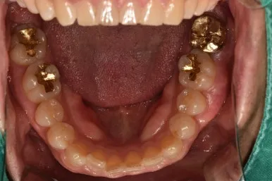 아래턱 씹는 면 전체 구강 사진, 양쪽 어금니에 오래된 금 보철물이 여러 개 들어가 있는 모습