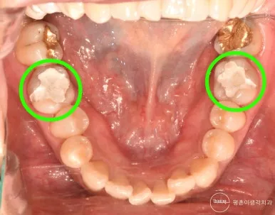 아래턱 씹는 면 전체 구강 사진, 양쪽 아래 어금니에 채워진 흰색 임시재료를 초록 원으로 표시