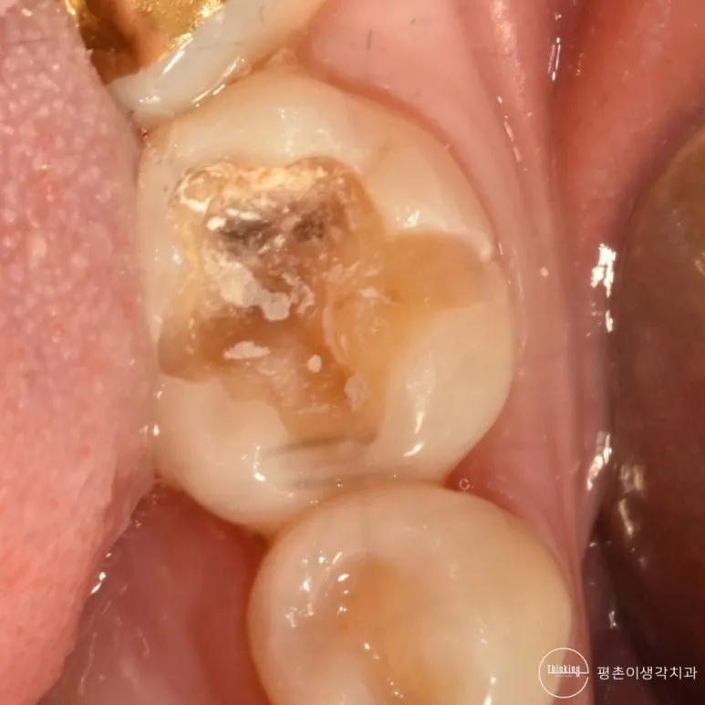 임시재료를 걷어낸 왼쪽 아래 어금니 씹는 면, 갈색으로 변색된 우식이 남아 있는 상태