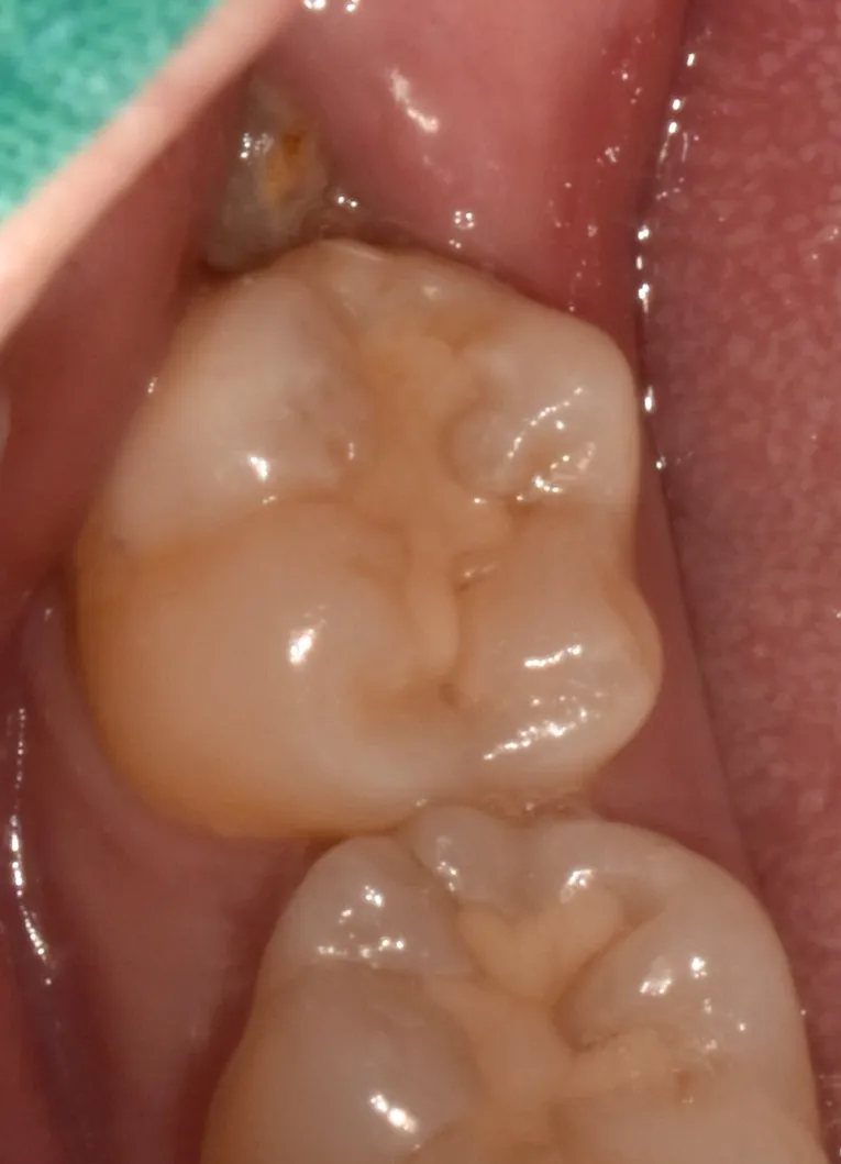 4. 보철물 경계 문제