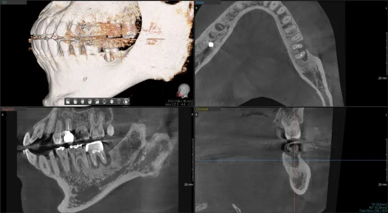 어금니 뿌리 끝 주변 병소를 확인한 3차원 CT 영상