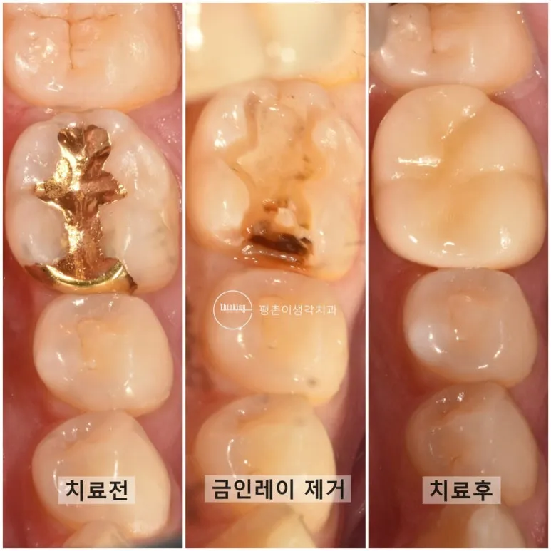 치료 전, 금 인레이 제거 직후, 치료 후 세 시점의 어금니 씹는 면을 나란히 비교한 사진