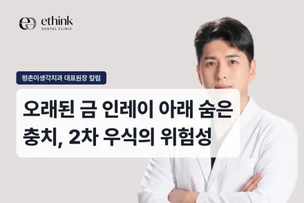 오래된 금 인레이 아래 숨은 충치, 2차 우식의 위험성