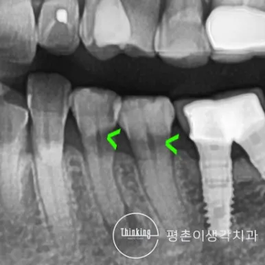 아래 어금니 치경부에 쐐기 모양 결손이 초록 화살표로 표시된 치료 전 치근단 방사선 사진