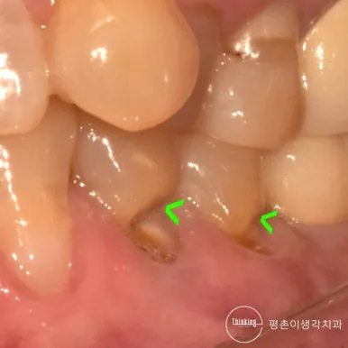 아래 어금니 두 곳의 치경부가 V자로 패인 부위를 초록 화살표로 표시한 치료 전 협측 구내 사진