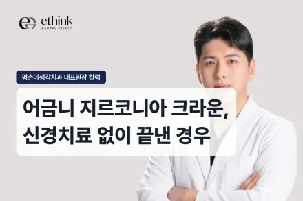 어금니 지르코니아 크라운, 신경치료 없이 끝낸 경우