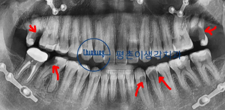 치료 전 파노라마 방사선 사진, 우식이 진행된 여러 부위를 붉은 화살표로 표시