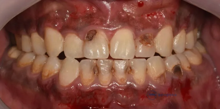 앞니 충치를 제거하고 레진으로 채워 나가는 중인 정면 구강 사진