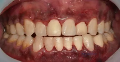 임시 보철을 장착한 뒤 촬영한 정면 구강 사진