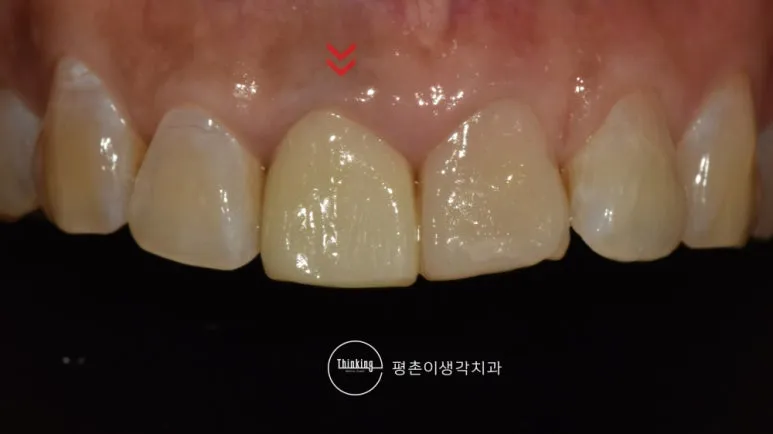 상악 중절치 두 개가 인접 측절치보다 누렇게 변색된 상태를 화살표로 표시한 치료 전 근접 구내 사진