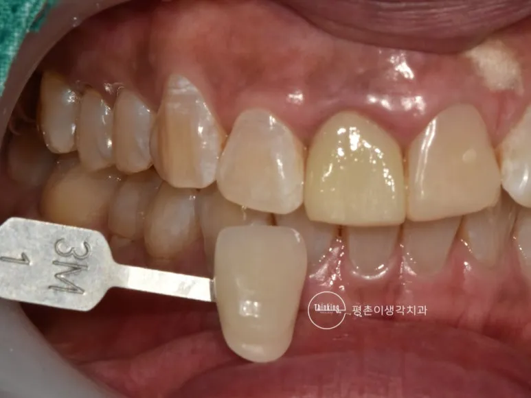3M 셰이드 탭을 변색된 상악 중절치 옆에 대고 무삭제 라미네이트 색조를 비교하는 측방 구내 사진
