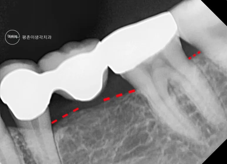 3본 브릿지와 지대치 주변 잇몸뼈 높이를 붉은 점선으로 표시한 치근단 방사선 사진