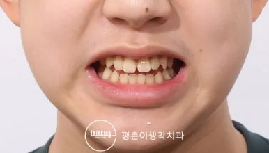 치료 전 정면 안모, 위아래 앞니가 서로 닿지 않는 개방교합 상태