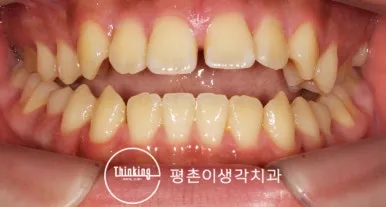 치료 전 정면 구내 사진, 앞니가 맞닿지 않고 가운데가 벌어진 정중이개
