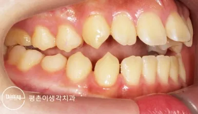 치료 전 오른쪽 구내 사진, 앞니가 닿지 않는 개방교합