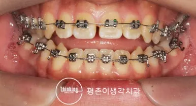 전악에 메탈 브라켓을 붙이고 가는 와이어로 배열을 시작한 정면 구내 사진
