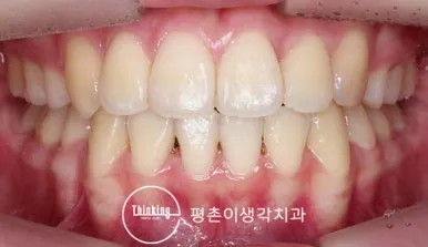 치료 후 정면 구내 사진, 앞니가 맞닿고 가운데 틈이 닫힌 모습