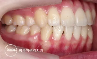 치료 후 오른쪽 구내 사진, 안정되게 맞물린 상태