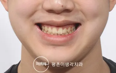 치료 후 정면 안모, 앞니가 맞닿는 상태