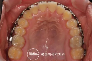 위턱을 씹는 면에서 본 MEAW 다중 루프 와이어
