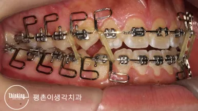MEAW 와이어에 악간 고무줄을 함께 건 오른쪽 구내 사진