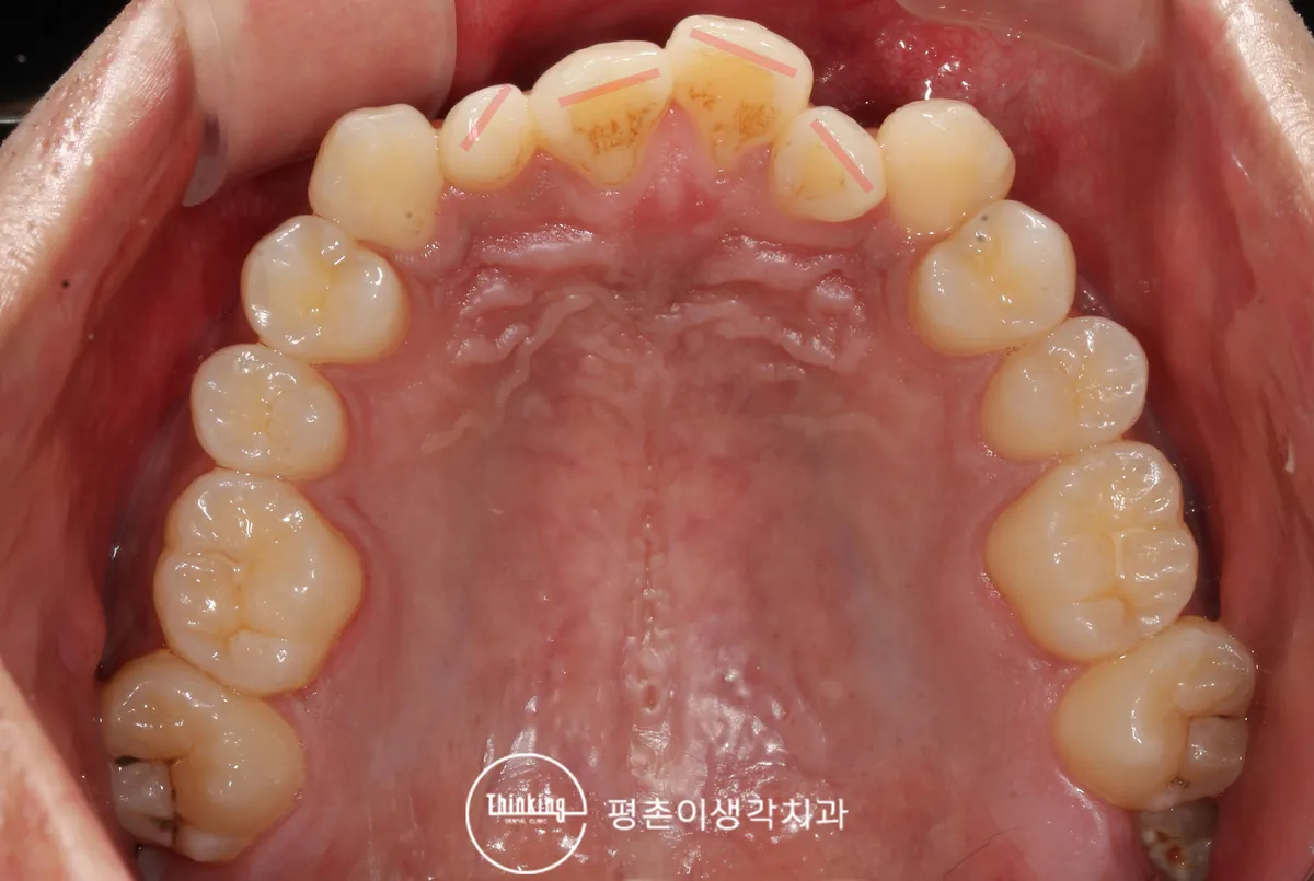 교정 전 위턱을 씹는 면에서 본 앞니 배열과 겹침