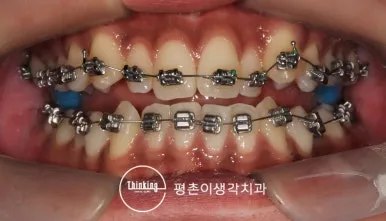 위아래 치아에 교정 장치를 부착한 정면 구강 사진
