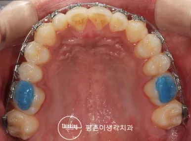 바이트 레진을 유지한 채 위턱 앞니가 배열되어 가는 경과 사진