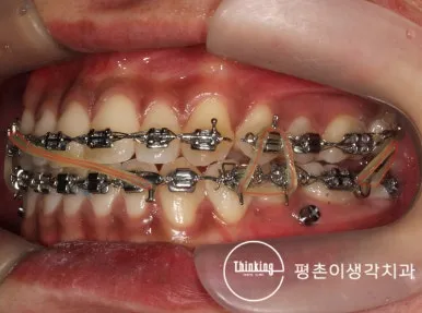 삼각형 모양으로 연결한 악간 고무줄 착용 사진