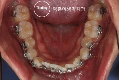 아래턱에 교정 장치를 부착한 상태를 씹는 면에서 본 사진