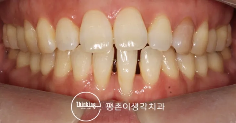 치료 전 정면 구강 사진, 잇몸이 내려앉아 아래 앞니 사이에 틈이 생긴 상태