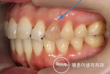외상 뒤 어둡게 변색된 오른쪽 위 송곳니를 파란 화살표로 표시한 측면 구강 사진