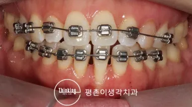 앞니 부위에만 브라켓을 부착한 부분교정 정면 사진