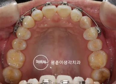 위턱을 씹는 면에서 본 부분교정 장치와 와이어