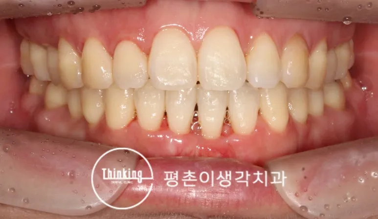 부분교정으로 앞니 사이 틈을 닫은 치료 후 정면 구강 사진