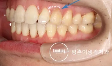 실활치 미백 뒤 밝아진 오른쪽 위 송곳니를 파란 화살표로 표시한 측면 구강 사진