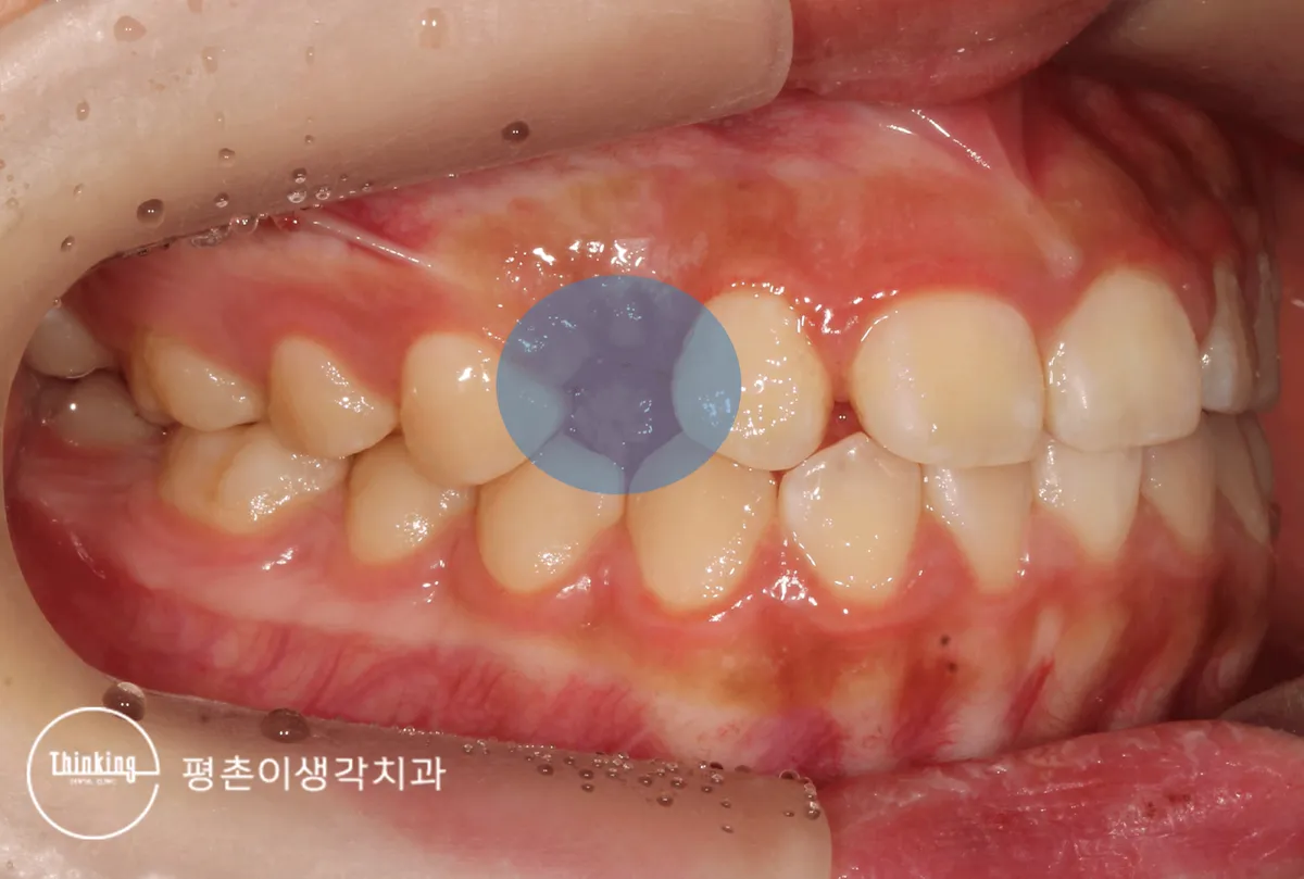 덧니는 왜 생기나요