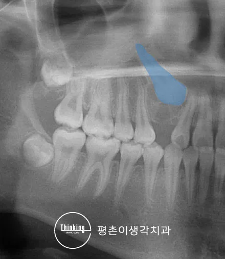 견인은 어떻게 하나요