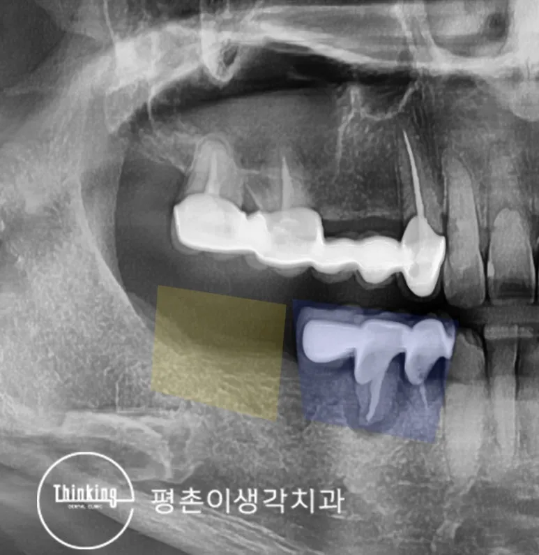 보철물 아래 치아 뿌리 주변 염증과 잇몸뼈 소실 범위를 색으로 표시한 방사선 사진