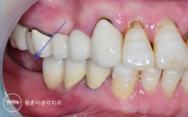 흔들리던 보철 부위를 화살표로 표시한 치료 전 구강 사진